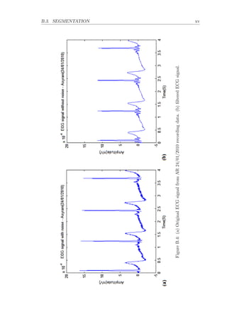 B.3. SEGMENTATION xv
FigureB.4:(a)OriginalECGsignalfromAR24/01/2010recordingdata.(b)ﬁlteredECGsignal.
 
