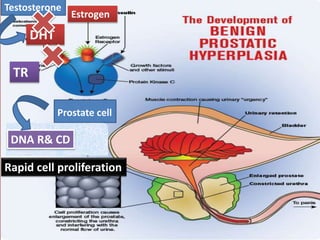 DHT
Estrogen
Testosterone
TR
Prostate cell
DNA R& CD
Rapid cell proliferation
 