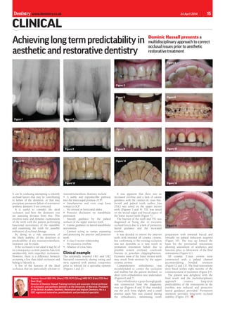 15Dentistry www.dentistry.co.uk 24 April 2014
clinical
It can be confusing attempting to identify
occlusal factors that may be contributing
to failure of the dentition, or that may
precipitate premature failure of restorative/
aesthetic dentistry if not corrected.
It is useful to consider the ideal
occlusion and how the dentition you
are assessing deviates from this. This
involves static and dynamic examination
of the teeth with the patient performing
functional movements of the mandible
and examining the teeth for possible
indicators of occlusal damage.
By doing so a risk assessment of
the likely stability of the dentition or
predictability of any restorative/aesthetic
treatment can be made.
If the occlusion is not ideal it may be of
no consequence as most patients function
satisfactorily with imperfect occlusions.
However, there is a difference between
accepting a less than ideal occlusion and
failing to identify it.
A few of the features of the ideal
occlusion that are particularly relevant to
restorative/aesthetic dentistry include:
•	 A stable and reproducible pathway
into the intercuspal position (ICP)
•	 Simultaneous and even cusp fossa
contact in ICP
-	 No vertical or horizontal slides
•	 Posterior disclusion on mandibular
protrusion
-	 Smooth guidance by the palatal
surfaces of the upper anterior teeth
•	 Canine guidance on lateral mandibular
movements
-	 Canines acting as ramps separating
and protecting the anterior and posterior
teeth
•	 A class I incisor relationship
-	 No excessive overbite
•	 Absence of cross bites.
Clinical example
The minimally restored UR1 and UR2
fractured extensively during eating and
were repaired with pinned composites
prior to referral for a specialist opinion
(Figures 1 and 2).
It was apparent that there was an
increased overbite and a lack of canine
guidance with the canines in cross bite.
Incisal and palatal tooth surface loss
(TSL) was noted on the upper incisor
teeth (Figures 3 and 4). TSL was noted
on the incisal edges and buccal aspect of
the lower incisor teeth (Figure 5).
The fracture of the teeth and TSL was
diagnosed as being due to excessive
occlusal forces due to a lack of protective
lateral guidance and the increased
overbite.
It was decided to restore the anterior
teeth with minimal all ceramic crowns,
but conforming to the existing occlusion
was not desirable as it may result in
premature restoration failure due to
possible cement overload, core/tooth
fracture or porcelain chipping/fracture.
Excessive wear of the lower incisor teeth
may result from attrition by the upper
ceramic crowns.
Comprehensive orthodontics was
recommended to correct the occlusion
and midline but the patient declined, so
short term orthodontics was undertaken
(Figures 6 and 7).
Post orthodontics a prep through guide
was constructed from the diagnostic
wax up (Figures 8 and 9) that rounded
out the arch form slightly and a small
anterior open bite was created during
the orthodontics, minimising tooth
Figure 1 Figure 2
Achievinglongtermpredictabilityin
aestheticandrestorativedentistry
Dominic Hassall presents a
multidisciplinary approach to correct
occlusal issues prior to aesthetic
restorative treatment
Dominic Hassall BDS MSc (Manc) FDS RCPS (Glasg) MRD RCS (Edin) FDS Rest
Dent (Eng).
Director of Dominic Hassall Training Institute and associate clinical professor
of restorative and aesthetic dentistry at the University of Warwick. President
of the British Academy Aesthetic Restorative and Implant Dentistry. He is a
GDC registered restorative, prosthodontic and periodontal specialist.
Figure 3
Figure 4
Figure 5 Figure 6
Figure 7
Figure 11
Figure 9
Figure 13
Figure 8
Figure 12
Figure 10
Figure 14
preparation with minimal buccal and
virtually no palatal reduction required
(Figure 10). The wax up formed the
basis for the provisional restorations
allowing assessment of aesthetics and
function prior to fabrication of the final
restorations (Figure 11).
All ceramic E.max crowns were
constructed with a palatal channel
accommodating bonded retention
(Figure 12 and 13). The final restorations
were fitted within eight months of the
commencement of treatment (Figure 14).
The patient was delighted with the
final result and the multidisciplinary
approach ensures long-term
predictability of the restorations as the
overbite was reduced and protective
lateral guidance provided. Permanent
retention provides long-term occlusal
stability (Figure 15).
Figure 15
 