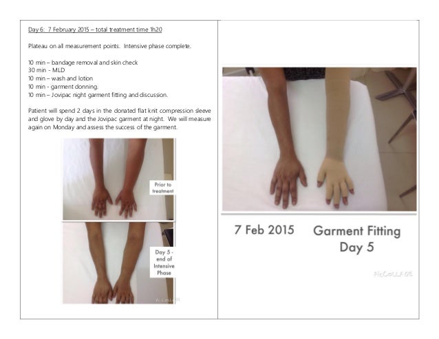 Lymphedema success stories image