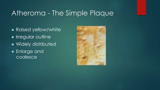 Atheroma - The Simple Plaque
 Raised yellow/white
 Irregular outline
 Widely distributed
 Enlarge and
coalesce
 