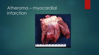 Atheroma – myocardial
infarction
 