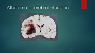 Atheroma – cerebral infarction
 