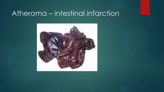 Atheroma – intestinal infarction
 