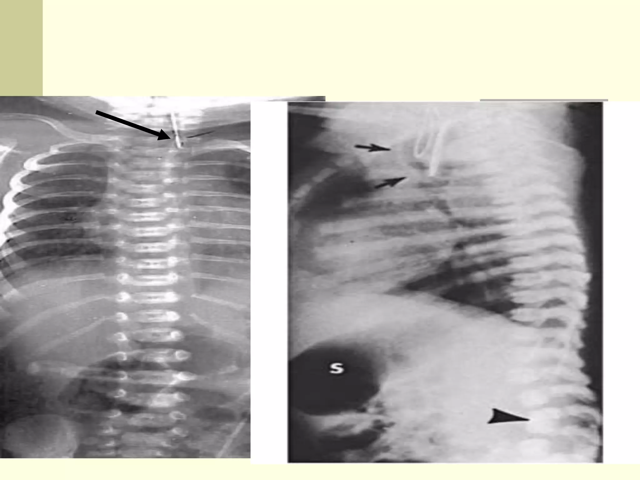  Frontal view of the
chest and abdomen of
a neonate
demonstrates a tube
in the proximal pouch
in this patient with EA.
The presence of bowel
gas implies the
presence of a distal
TEF.
 