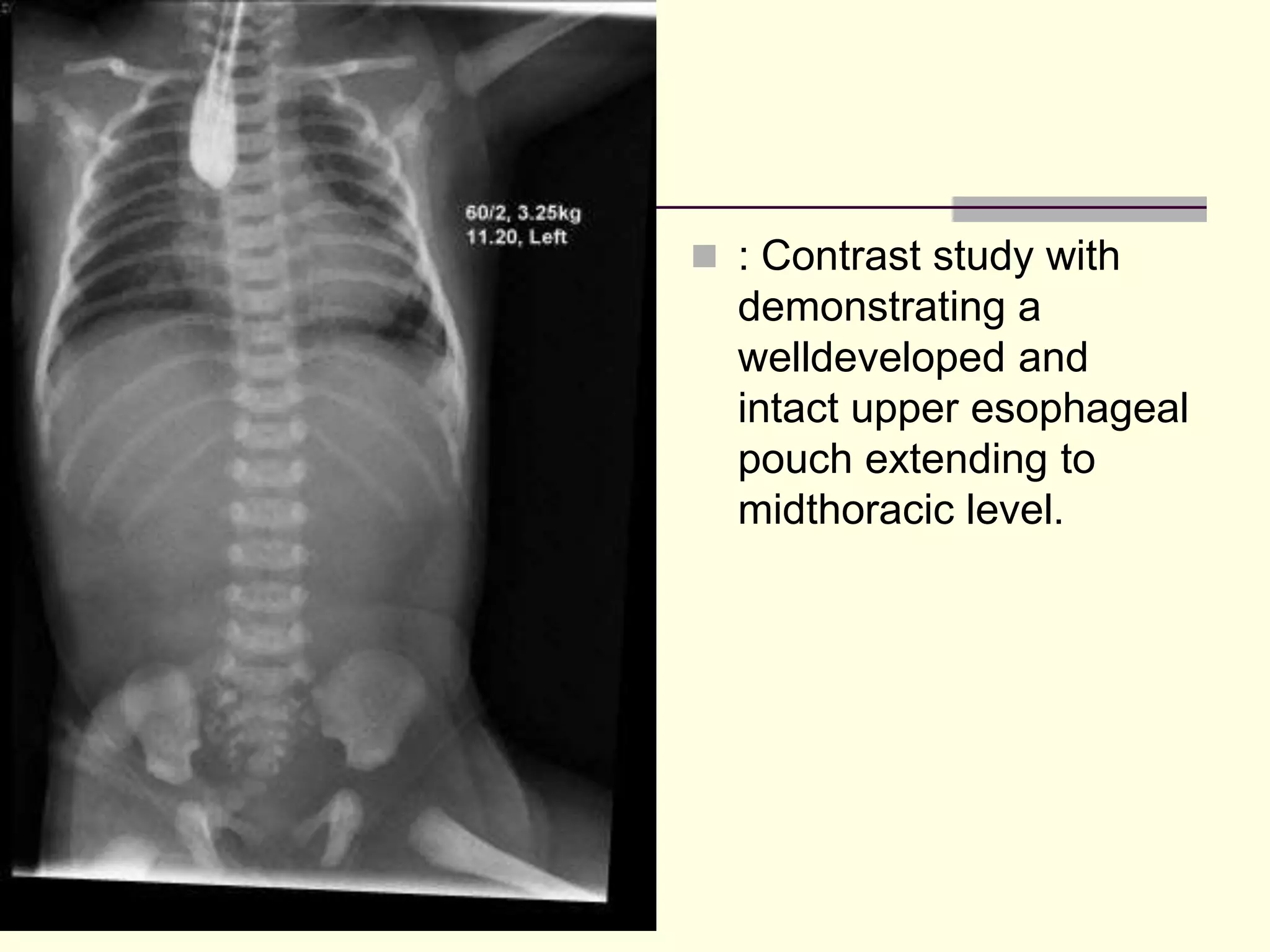  : Contrast study with
demonstrating a
welldeveloped and
intact upper esophageal
pouch extending to
midthoracic level.
 