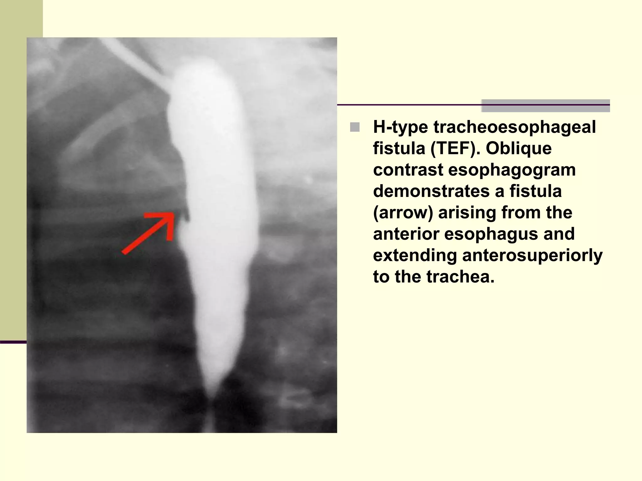  H-type tracheoesophageal
fistula (TEF). Oblique
contrast esophagogram
demonstrates a fistula
(arrow) arising from the
anterior esophagus and
extending anterosuperiorly
to the trachea.
 