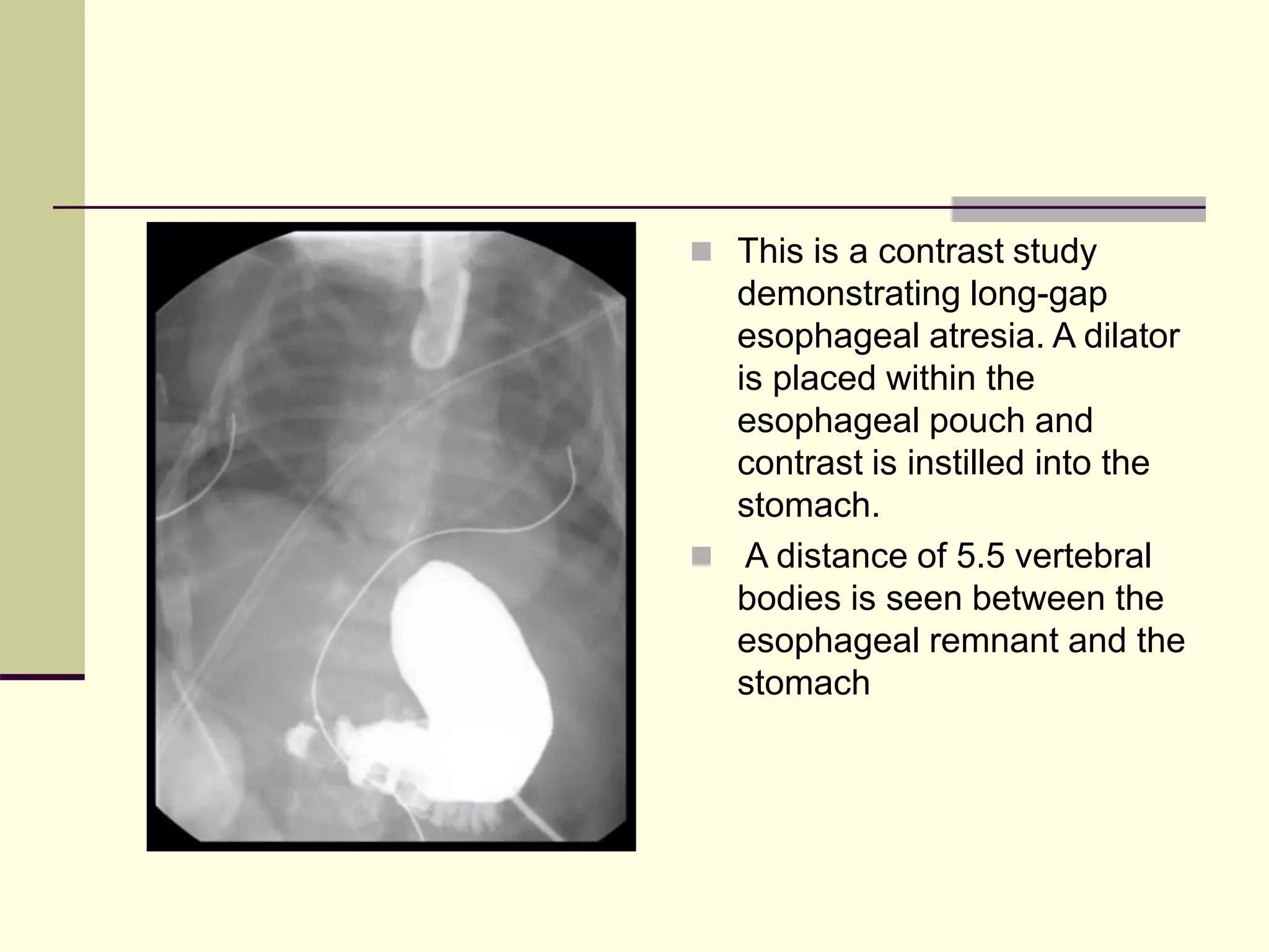  This is a contrast study
demonstrating long-gap
esophageal atresia. A dilator
is placed within the
esophageal pouch and
contrast is instilled into the
stomach.
 A distance of 5.5 vertebral
bodies is seen between the
esophageal remnant and the
stomach
 
