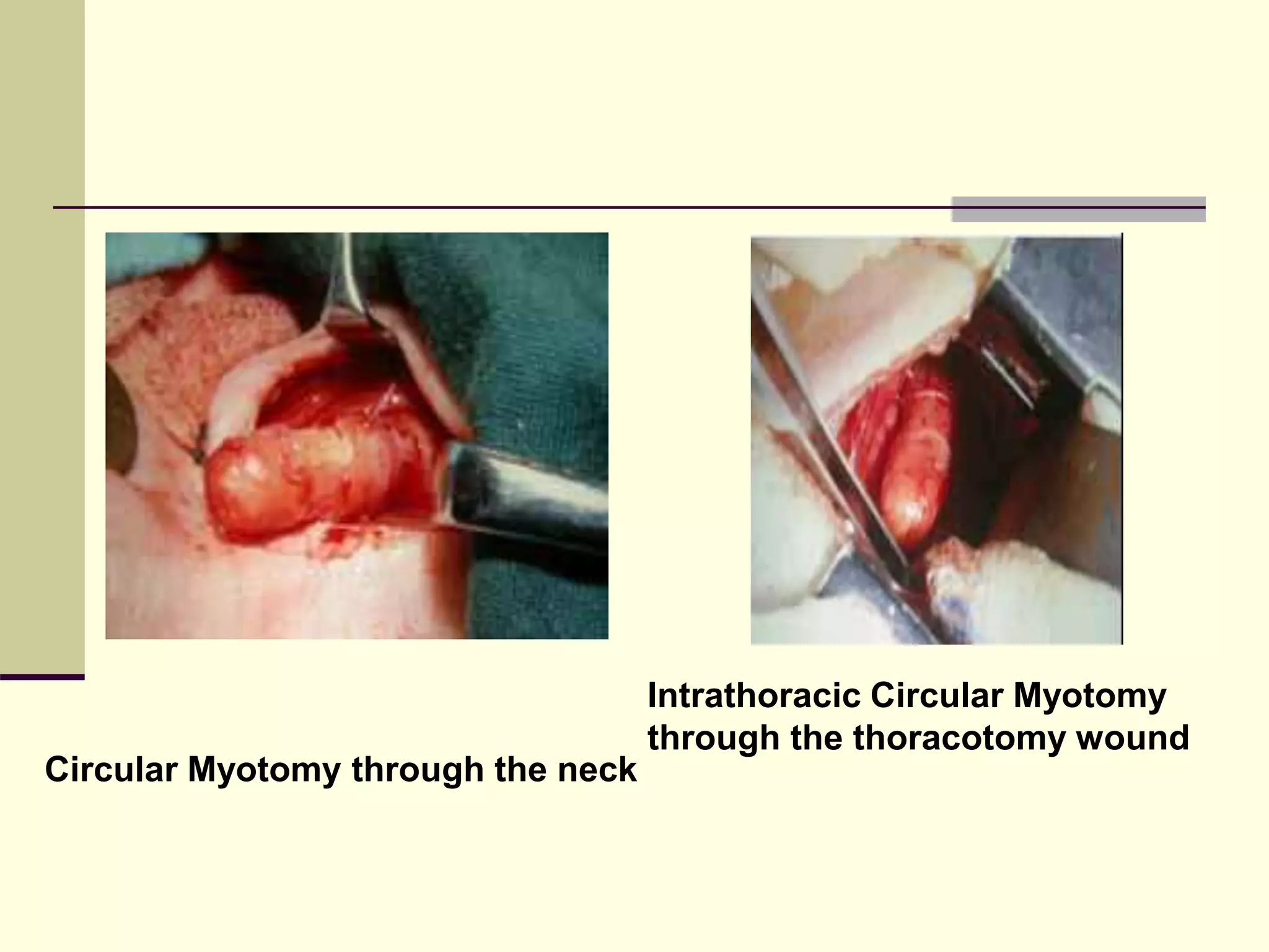 Circular Myotomy through the neck
Intrathoracic Circular Myotomy
through the thoracotomy wound
 