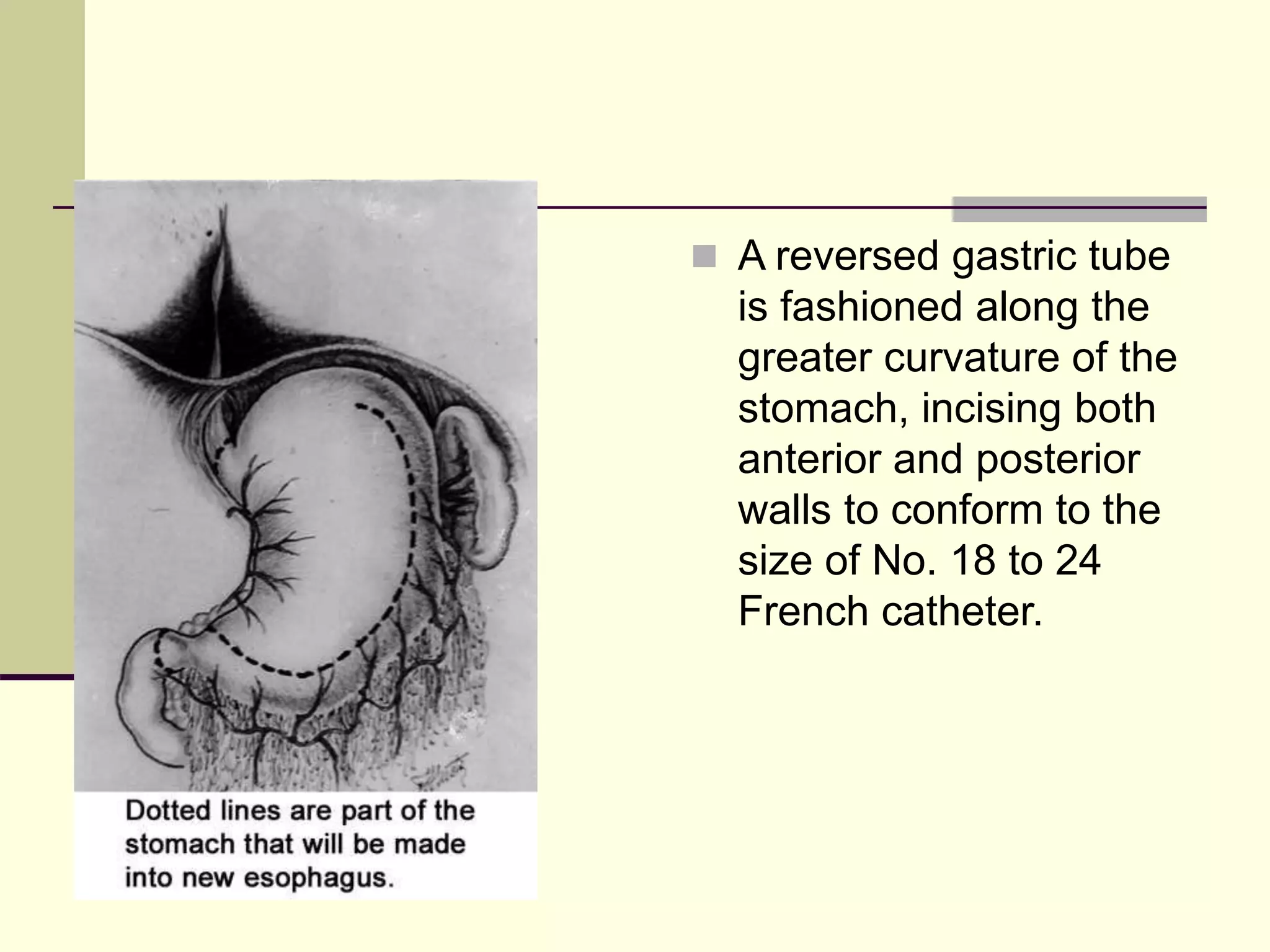  A reversed gastric tube
is fashioned along the
greater curvature of the
stomach, incising both
anterior and posterior
walls to conform to the
size of No. 18 to 24
French catheter.
 