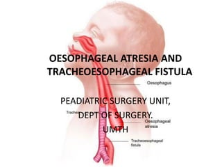 OESOPHAGEAL ATRESIA AND
TRACHEOESOPHAGEAL FISTULA
PEADIATRIC SURGERY UNIT,
DEPT OF SURGERY.
UMTH
 