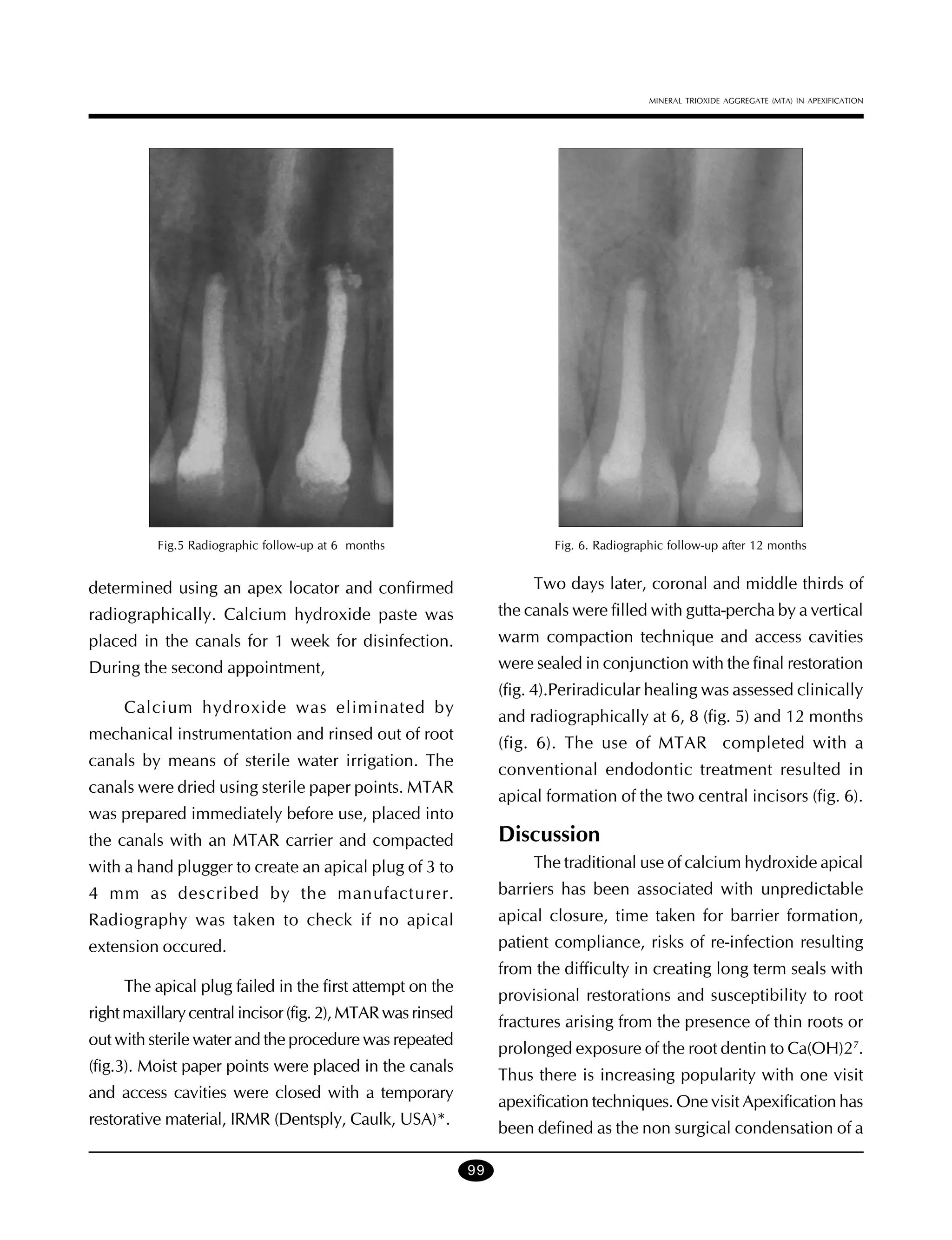 MINERAL TRIOXIDE AGGREGATE (MTA) IN APEXIFICATION

Fig.5 Radiographic follow-up at 6 months

Fig. 6. Radiographic follow-up after 12 months

determined using an apex locator and confirmed

Two days later, coronal and middle thirds of

radiographically. Calcium hydroxide paste was

the canals were filled with gutta-percha by a vertical

placed in the canals for 1 week for disinfection.

warm compaction technique and access cavities

During the second appointment,

were sealed in conjunction with the final restoration
(fig. 4).Periradicular healing was assessed clinically

Calcium hydroxide was eliminated by

and radiographically at 6, 8 (fig. 5) and 12 months

mechanical instrumentation and rinsed out of root

(fig. 6). The use of MTAR completed with a

canals by means of sterile water irrigation. The

conventional endodontic treatment resulted in

canals were dried using sterile paper points. MTAR

apical formation of the two central incisors (fig. 6).

was prepared immediately before use, placed into

Discussion

the canals with an MTAR carrier and compacted
with a hand plugger to create an apical plug of 3 to

The traditional use of calcium hydroxide apical

4 mm as described by the manufacturer.

barriers has been associated with unpredictable

Radiography was taken to check if no apical

apical closure, time taken for barrier formation,

extension occured.

patient compliance, risks of re-infection resulting
from the difficulty in creating long term seals with

The apical plug failed in the first attempt on the

provisional restorations and susceptibility to root

right maxillary central incisor (fig. 2), MTAR was rinsed

fractures arising from the presence of thin roots or

out with sterile water and the procedure was repeated

prolonged exposure of the root dentin to Ca(OH)27.

(fig.3). Moist paper points were placed in the canals

Thus there is increasing popularity with one visit

and access cavities were closed with a temporary

apexification techniques. One visit Apexification has

restorative material, IRMR (Dentsply, Caulk, USA)*.

been defined as the non surgical condensation of a
99

 