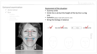 face center -Nose swing 
+/-side 
Ri 
Le 
commissure line 
⎪EXAMINATION 
Extraoralexamination 
dentolabial 
face 
middline 
philtrummidline 
noseswing 
kommsurline 
Assessment of the situation: 
•Gummy smile 
•Smile line is ok but the height of the lip line is a big one 
•Esthetics (gingiva, length width proportion, color) 
•Bring the biology in balance  