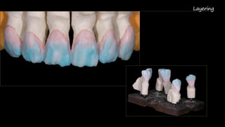 Layering  
