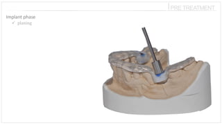⎪PRETREATMENT 
Implant phase 
planing  