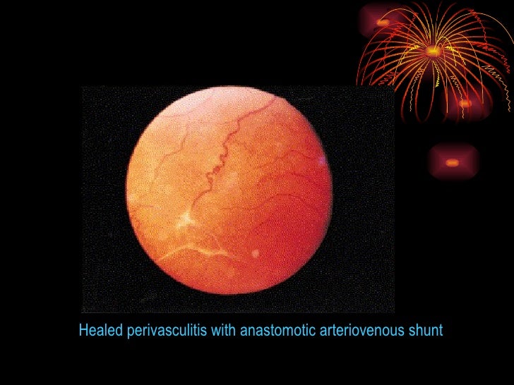 Periphlebitis Retinae [Eale’S Disease] – VLYY