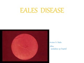 EALES DISEASE
dr.nirav b. Dadia
fellow
nandadeep eye hospital
 