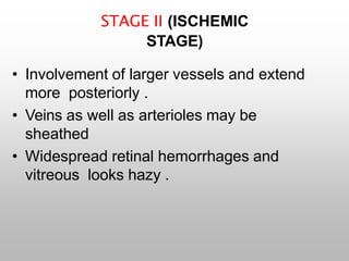 STAGE II (ISCHEMIC
STAGE)
• Involvement of larger vessels and extend
more posteriorly .
• Veins as well as arterioles may be
sheathed
• Widespread retinal hemorrhages and
vitreous looks hazy .
 