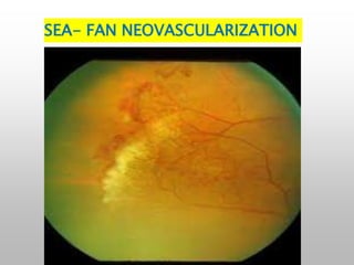 SEA- FAN NEOVASCULARIZATION
 