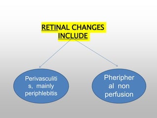 Perivasculiti
s, mainly
periphlebitis
RETINAL CHANGES
INCLUDE
Pheripher
al non
perfusion
 