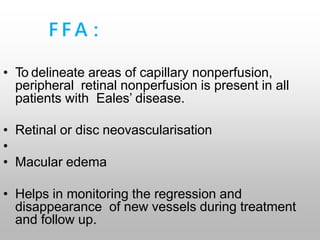 F F A :
• To delineate areas of capillary nonperfusion,
peripheral retinal nonperfusion is present in all
patients with Eales’ disease.
• Retinal or disc neovascularisation
•
• Macular edema
• Helps in monitoring the regression and
disappearance of new vessels during treatment
and follow up.
 