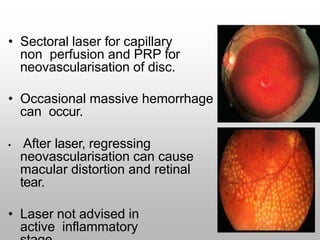 • Sectoral laser for capillary
non perfusion and PRP for
neovascularisation of disc.
• Occasional massive hemorrhage
can occur.
• After laser, regressing
neovascularisation can cause
macular distortion and retinal
tear.
• Laser not advised in
active inflammatory
 