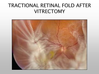 TRACTIONAL RETINAL FOLD AFTER
VITRECTOMY
 