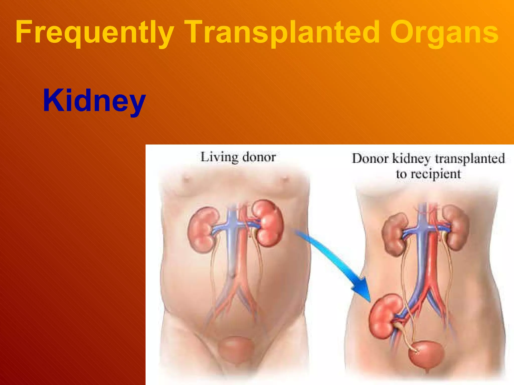 Frequently   Transplanted Organs Kidney 