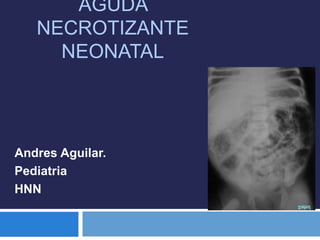 AGUDA 
NECROTIZANTE 
NEONATAL 
Andres Aguilar. 
Pediatria 
HNN 
 