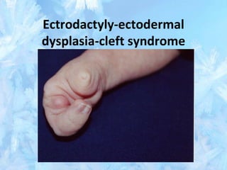 Ectrodactyly-ectodermal
dysplasia-cleft syndrome
 