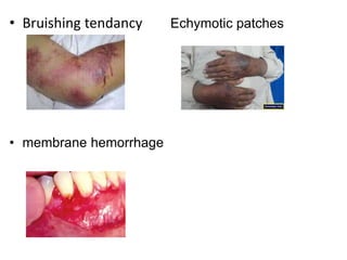 • Bruishing tendancy Echymotic patches
• membrane hemorrhage
 