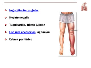 Ingurgitación yugular

Hepatomegalia

Taquicardia, Ritmo Galope

Uso mm accesorios, agitación

Edema periférico
 