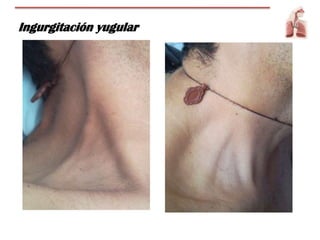 Ingurgitación yugular
 