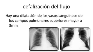 cefalización del flujo
Hay una dilatación de los vasos sanguíneos de
los campos pulmonares superiores mayor a
3mm
 