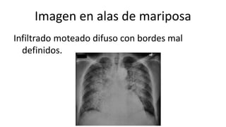 Imagen en alas de mariposa
Infiltrado moteado difuso con bordes mal
definidos.
 