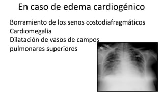 En caso de edema cardiogénico
Borramiento de los senos costodiafragmáticos
Cardiomegalia
Dilatación de vasos de campos
pulmonares superiores
 