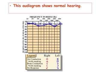 • This audiogram shows normal hearing.
 