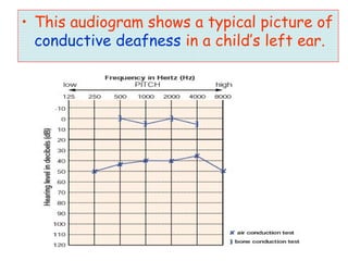 • This audiogram shows a typical picture of
conductive deafness in a child’s left ear.
 