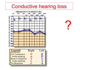 Conductive hearing loss
?
 