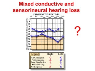 Mixed conductive and
sensorineural hearing loss
?
 