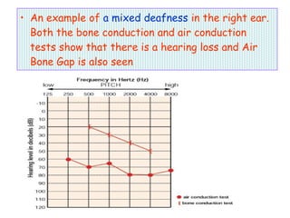 • An example of a mixed deafness in the right ear.
Both the bone conduction and air conduction
tests show that there is a hearing loss and Air
Bone Gap is also seen
 