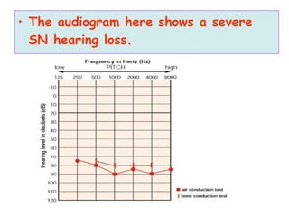 • The audiogram here shows a severe
SN hearing loss.
 
