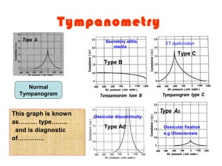 Tympanometry
This graph is known
as……… type……..
and is diagnostic
of………….
Normal
Tympanogram
Type Ad
Type B
Type C
Secretory otitis
media
ET dysfunction
Ossicular discontinuity
Ossicular fixation
e.g Otosclerosis
 