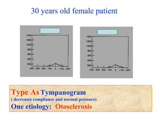 30 years old female patient
Q1 – Comment on the type of tympanograms.
Q2 – Give one possible etiology.
Type AsTympanogram
( decreases compliance and normal pressure)
One etiology: Otosclerosis
 