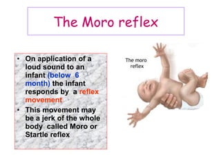 • On application of a
loud sound to an
infant (below 6
month) the infant
responds by a reflex
movement
• This movement may
be a jerk of the whole
body called Moro or
Startle reflex
The Moro reflex
 