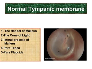 1- The Handel of Malleus
2-The Cone of Light
3-lateral process of
Malleus
4-Pars Tensa
5-Pars Flaccida
Normal Tympanic membrane
1
2
3
4
5
 