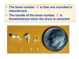 • The bone number…… is that one included in
otosclerosis
• The handle of the bone number…….. is
foreshortened when the drum is retracted
1 2 3
• The bone number 3 is that one included in
otosclerosis
• The handle of the bone number 1 is
foreshortened when the drum is retracted
 