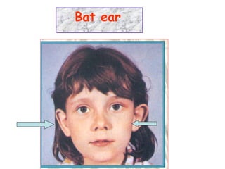 Bat earBat ear
 