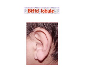 Bifid lobule
 