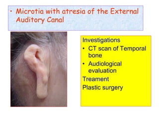 • Microtia with atresia of the External
Auditory Canal
Investigations
• CT scan of Temporal
bone
• Audiological
evaluation
Treament
Plastic surgery
 